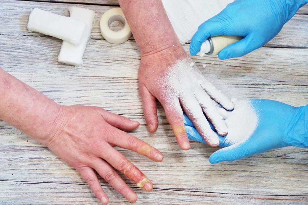 Panduan Praktis Merawat Luka Bakar Ringan di Rumah